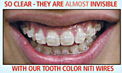 Invisible with our Tooth Color Niti Wires