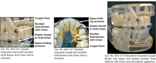 Labial and Palatal Impacted Cuspid Model with Gold Buttons and Chain