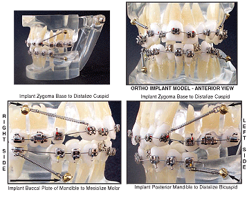 Orthodontic Implant Model